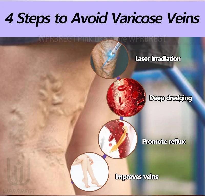 Eliminate vasculitis, phlebitis, relieve spider leg pain, varicose veins painless treatment