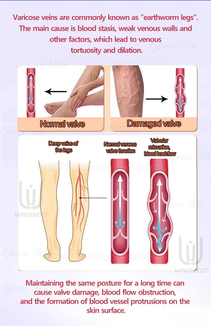 Eliminate vasculitis, phlebitis, relieve spider leg pain, varicose veins painless treatment