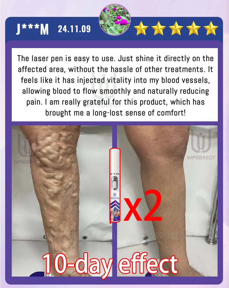 Eliminate vasculitis, phlebitis, relieve spider leg pain, varicose veins painless treatment