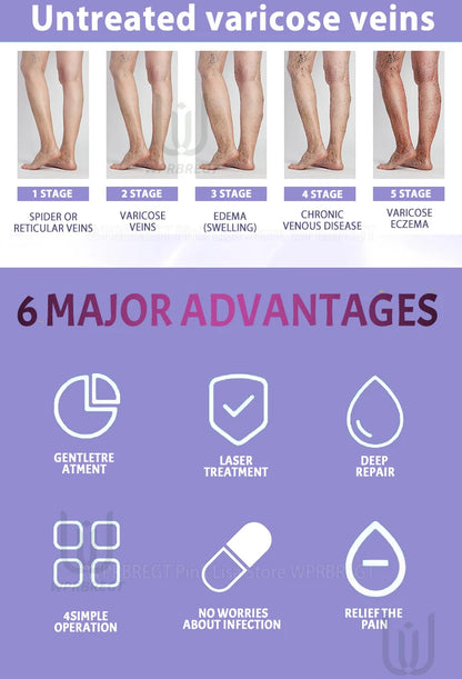 Eliminate vasculitis, phlebitis, relieve spider leg pain, varicose veins painless treatment