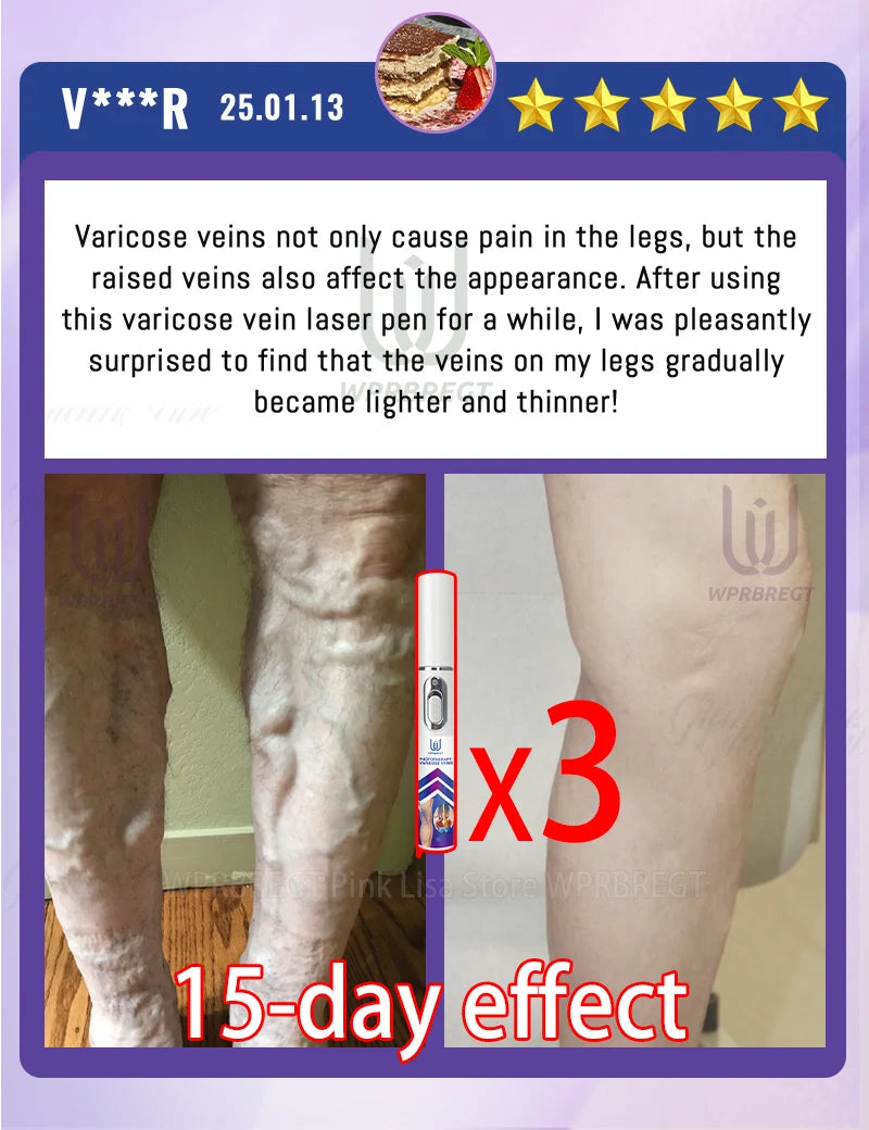 Eliminate vasculitis, phlebitis, relieve spider leg pain, varicose veins painless treatment