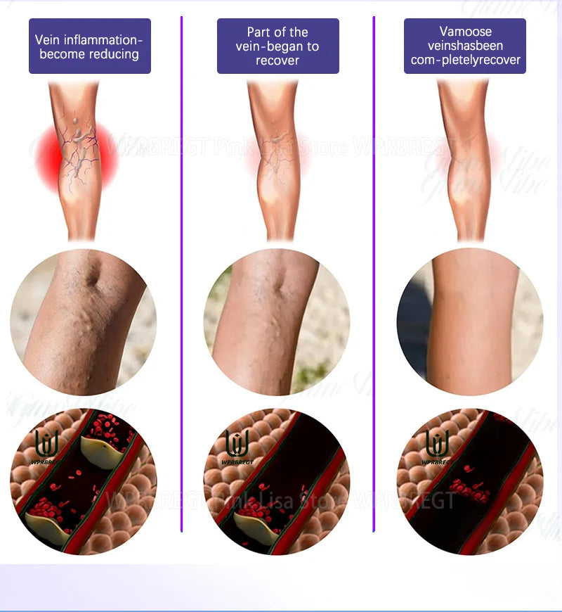 Eliminate vasculitis, phlebitis, relieve spider leg pain, varicose veins painless treatment