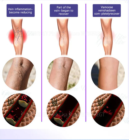 Eliminate vasculitis, phlebitis, relieve spider leg pain, varicose veins painless treatment