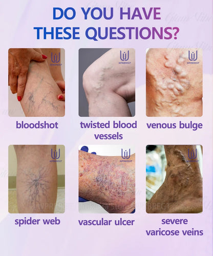 Eliminate vasculitis, phlebitis, relieve spider leg pain, varicose veins painless treatment