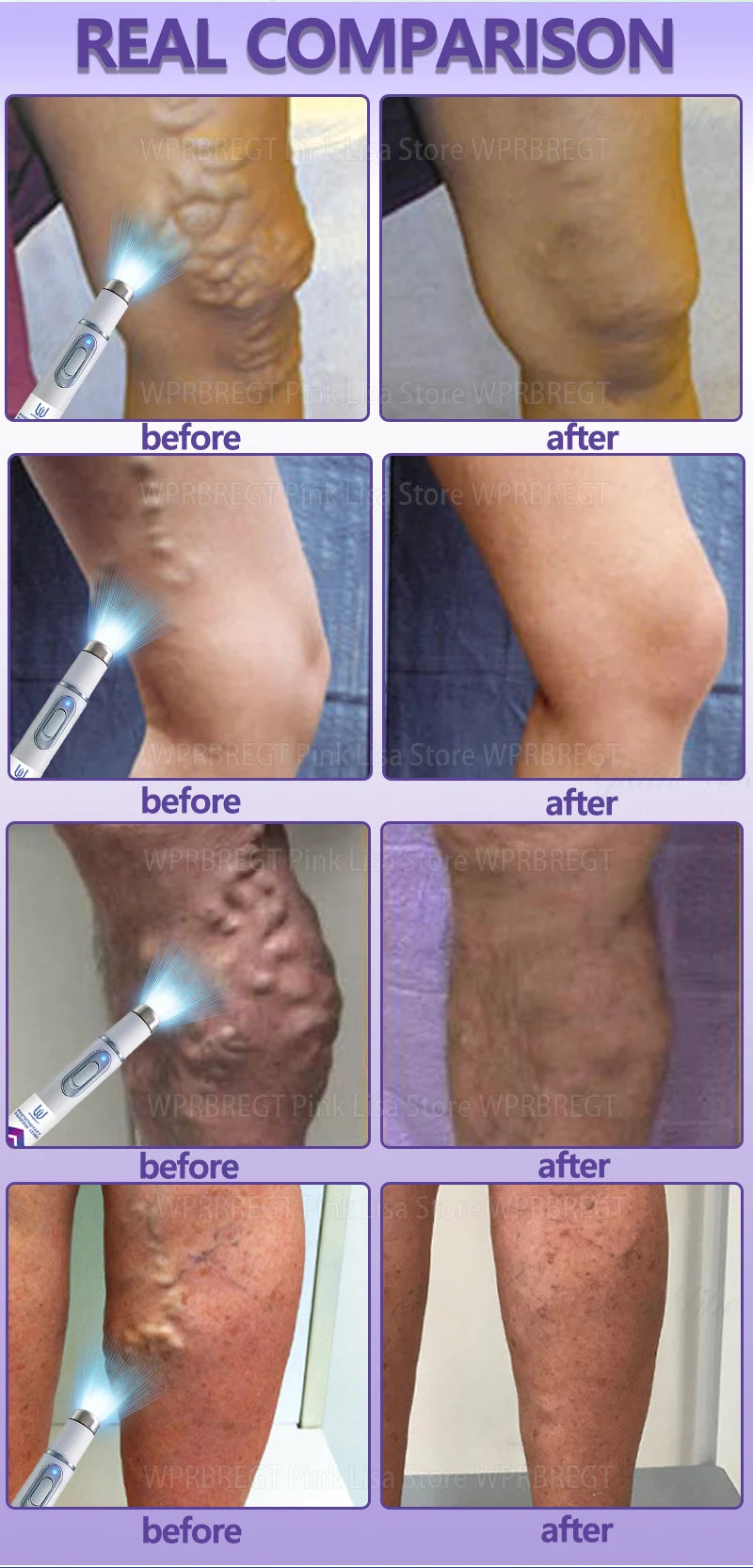 Eliminate vasculitis, phlebitis, relieve spider leg pain, varicose veins painless treatment