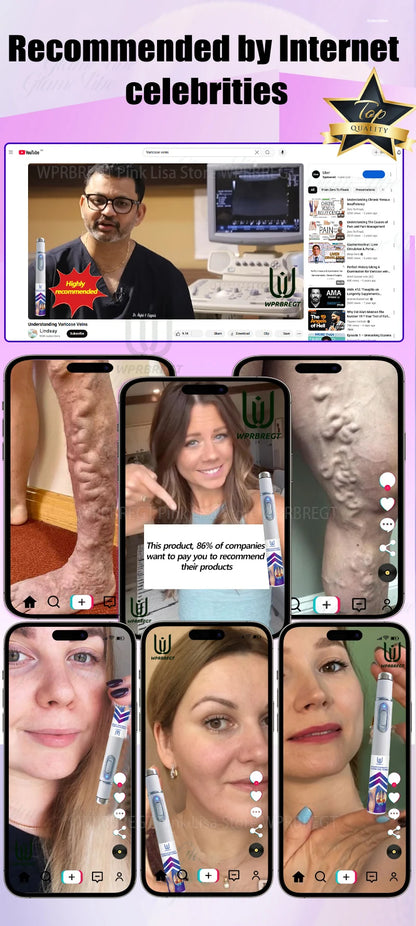 Eliminate vasculitis, phlebitis, relieve spider leg pain, varicose veins painless treatment