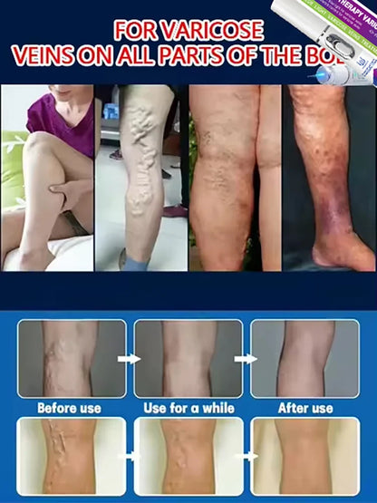 Eliminate vasculitis, phlebitis, relieve spider leg pain, varicose veins painless treatment