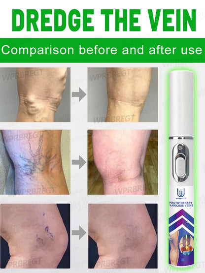 Eliminate vasculitis, phlebitis, relieve spider leg pain, varicose veins painless treatment