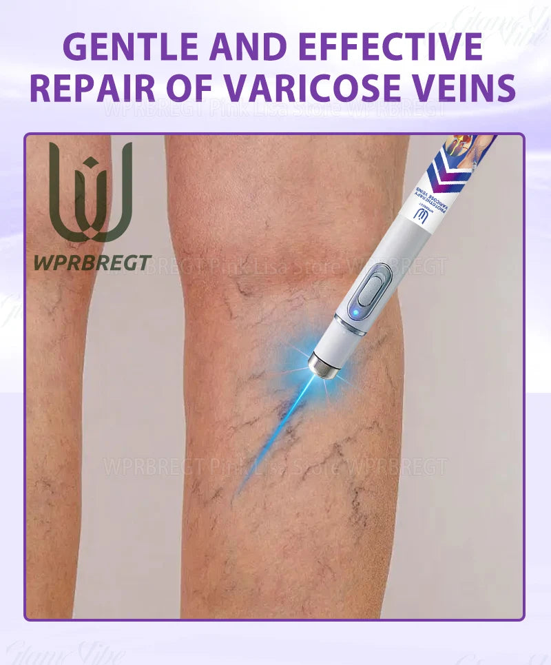 Eliminate vasculitis, phlebitis, relieve spider leg pain, varicose veins painless treatment