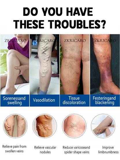 Eliminate vasculitis, phlebitis, relieve spider leg pain, varicose veins painless treatment
