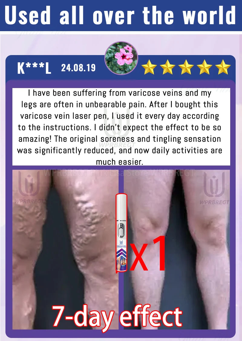 Eliminate vasculitis, phlebitis, relieve spider leg pain, varicose veins painless treatment